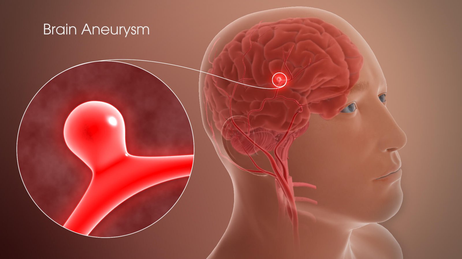 Brain Aneurysm
