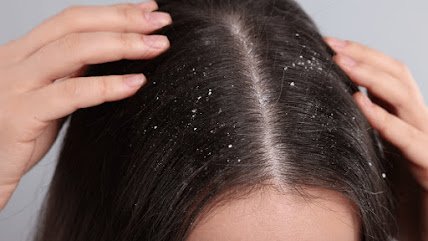Say Goodbye to Itchy Scalp - Expert Dandruff Solutions